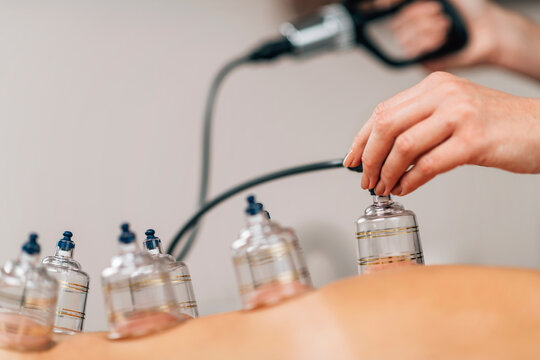 Electric Hijama